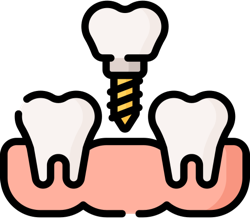 Implantes Dentários